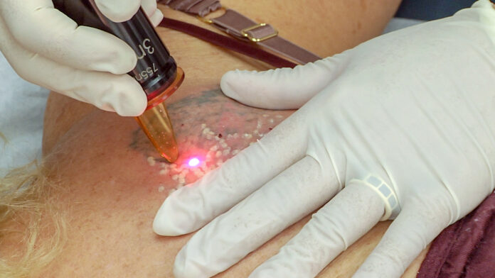 macchine laser per rimuovere i tatuaggi